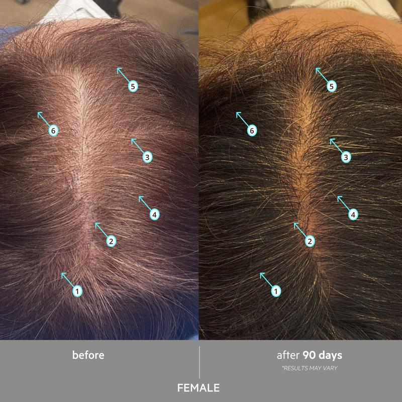 Simply Found EXTRA STRENGTH® — Anti-Gray Hair Density Serum (7% Nanoxidil + 3 DHT Inhibitors)